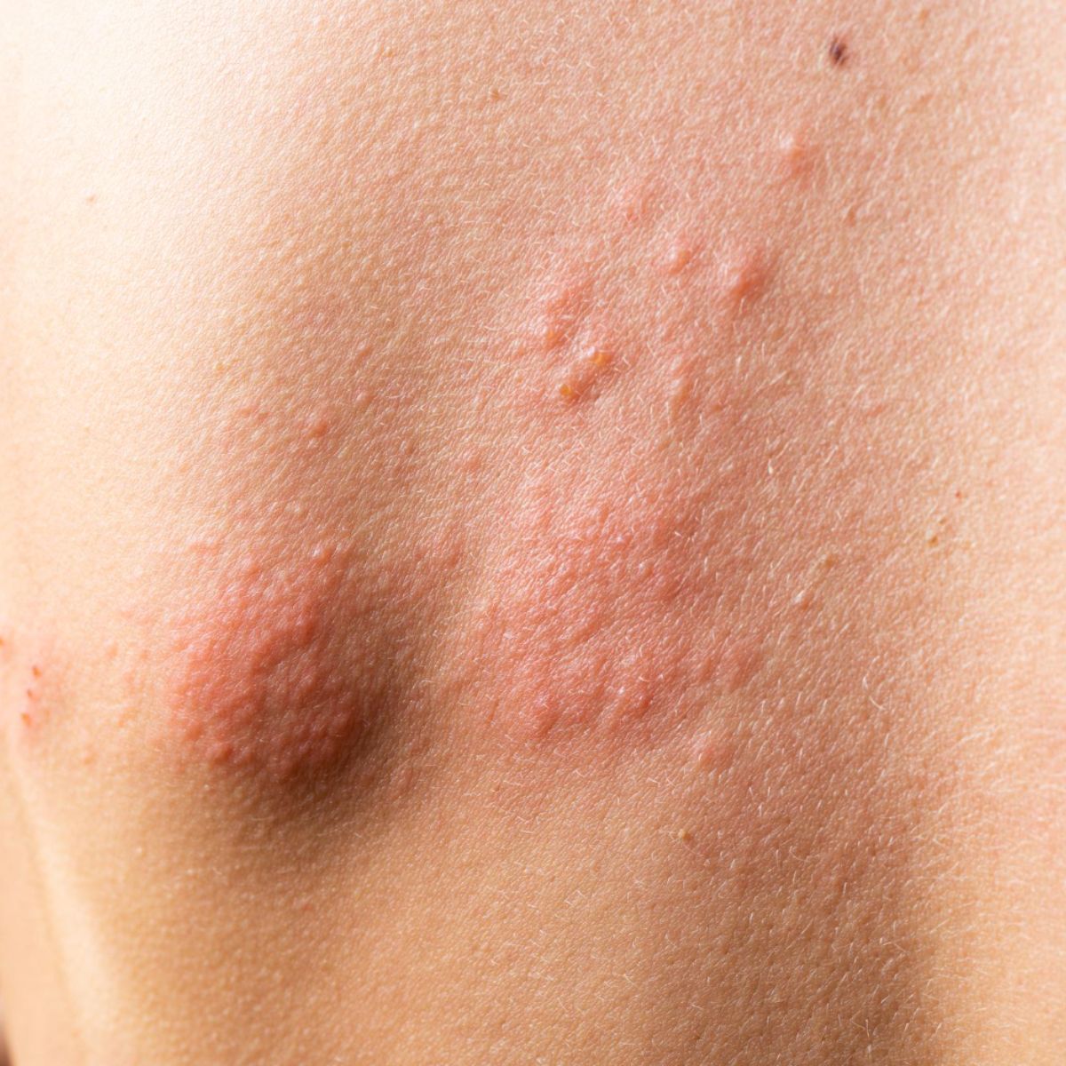 shingles